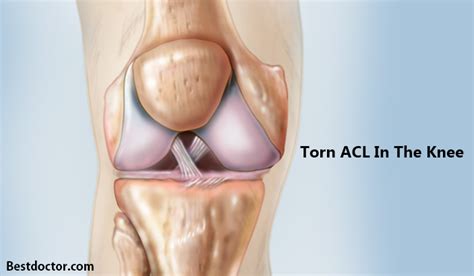 Torn ACL In The Knee- Symptoms, Causes, And Tips To Prevent