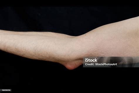 Elbow Bursitis Students Elbow Olecranon Bursitis | Images and Photos finder