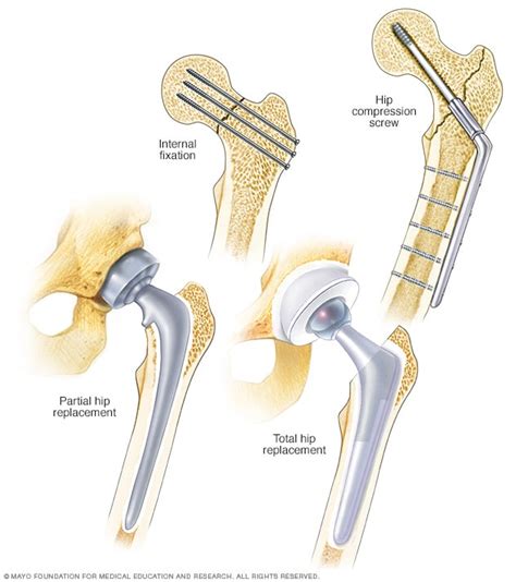 Hip Fracture