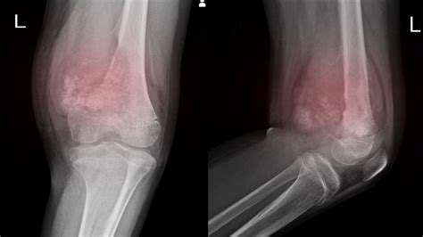 Soft Tissue Sarcoma: Symptoms and Causes