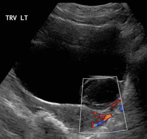 Bladder Cancer Ultrasound