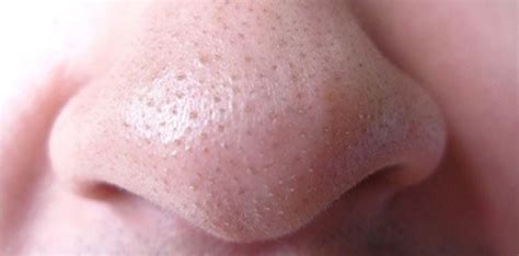 Clogged Nose Pores: Causes, Cleaning and Clearing - Skincarederm