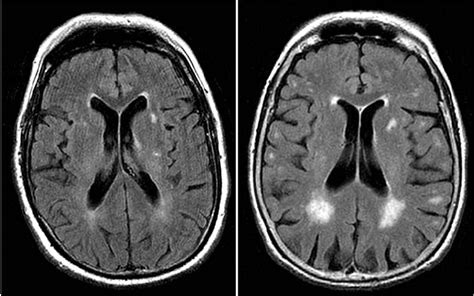 Health Information Guides: Brain MRI White Matter Intensities: Clinical Significance