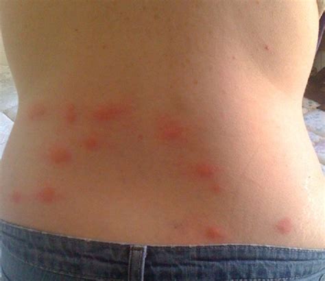 BED BUG BITES PICTURES BED BUG BITES ON BACK – BED BUG BITES and BED BUG TREATMENT