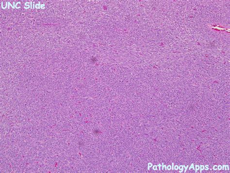 synovial sarcoma pathology