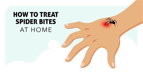 How to Treat Spider Bites at Home - Insight Pest Control