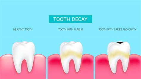 Do You Have Tooth Decay? Here's 5 Signs That You Might