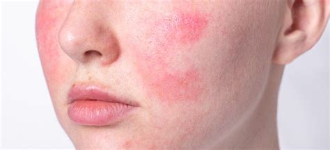 Rosacea Treatment: 6 Natural Remedies to Use - Dr. Axe