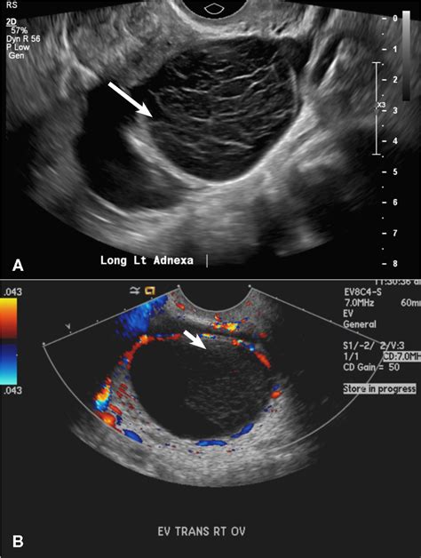 Ovarian Cyst On Ultrasound Image | sexiezpix Web Porn