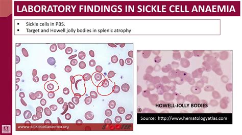 Sickle Cell Anemia Microscope