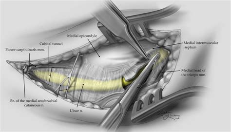 Ulnar Nerve Decompression at the Elbow - Kaitlin Lindsay