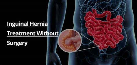 Hernia Diagram Of Inside Umbilical And Inguinal Hernia Men With Hernia | Porn Sex Picture