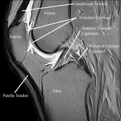 Radiology Anatomy Images : Patellar articular cartillage in MRI Knee joint anatomy