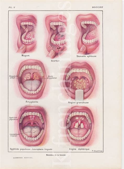 Mouth Diseases Anatomy Plate French Vintage Original Print 1920's Medical Curiosity Cabinet ...