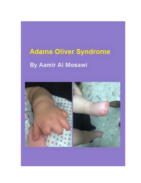 (PDF) Adams Oliver syndrome