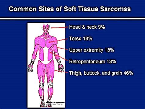 Soft Tissue Sarcoma Types