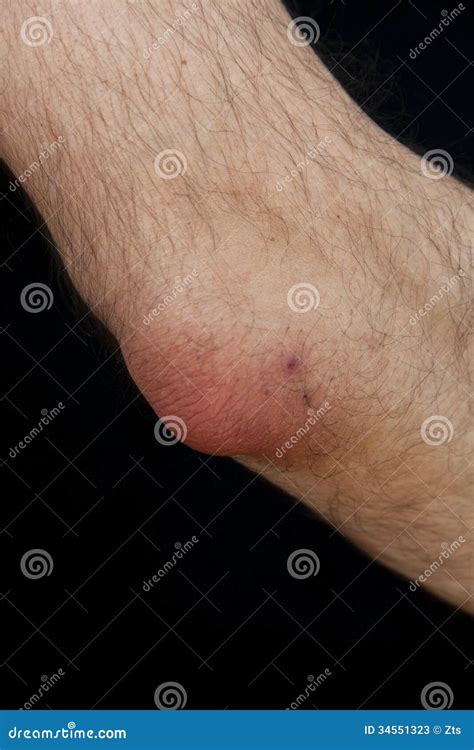 Olecranon Bursitis, Also Known As Student’s Elbow Stock Photos - Image: 34551323