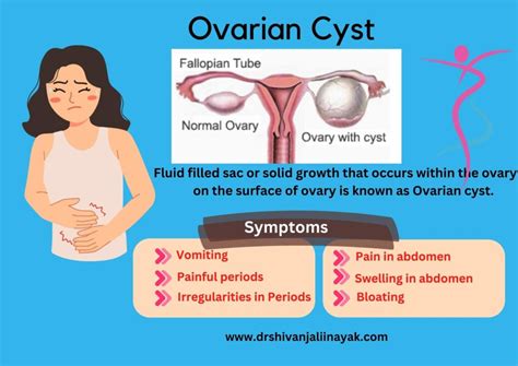 What is Ovarian Cyst and what are its symptoms and treatments? Dr Shivanjali Nayak