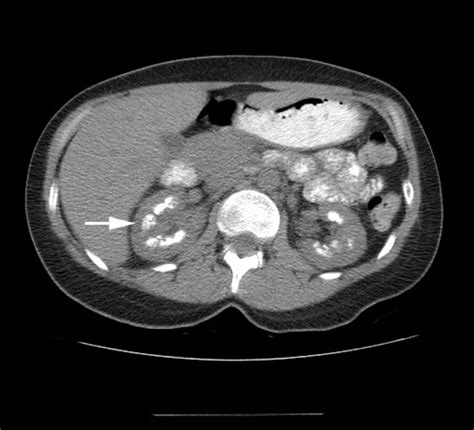 Image Diagnosis: Medullary Sponge Kidney | The Permanente Journal