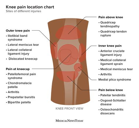 Knee pain location chart: Sites of different injuries