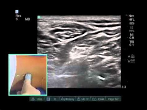 Popliteal Nerve Block Ultrasound