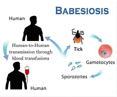 Babesiosis symptoms - MEDizzy