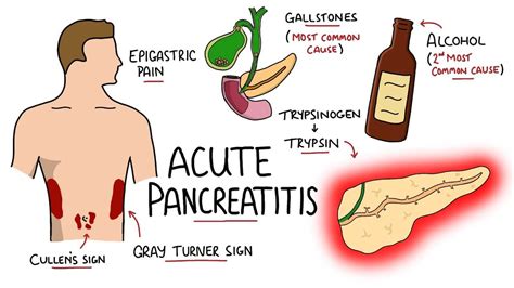 Akut Pankreatit için Homeopati Tedavisi – Homeopati Türkiye