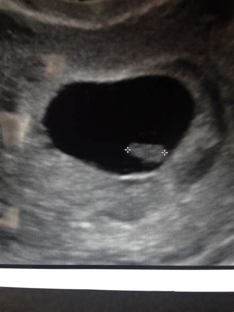 8 week ultrasound showing only fetal pole. No baby, no heartbeat, no yolk sac. — The Bump