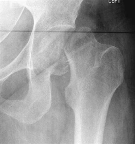 -Radiograph at presentation, showing a displaced subcapital fracture of... | Download Scientific ...