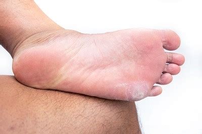 5 Common Skin Problems Found on the Feet | Cornerstone Foot & Ankle