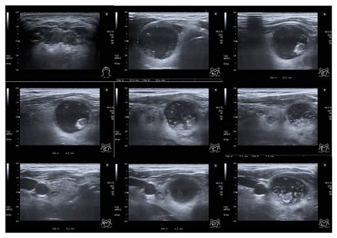 Supreme How To Understand Thyroid Ultrasound Results What Is Technical Maintenance Engineering