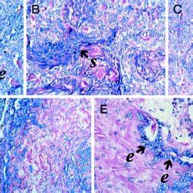 Histomorphological features of the synovial sarcoma (SS)-I considered... | Download Scientific ...