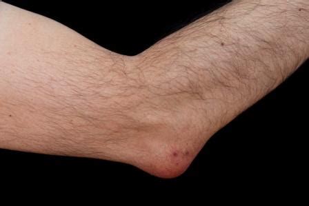 Student's Elbow: Olecranon Bursitis Causes, Symptoms, Treatment