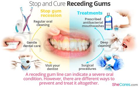 Stop and Cure Reciding Gums | SheCares