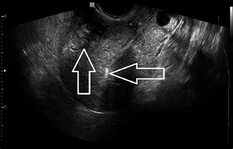 Intramural Fibroid Ultrasound