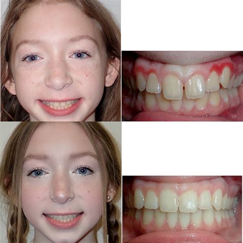 Braces Before And After Smile