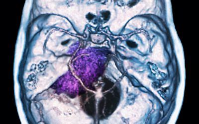 Parietal Lobe Stroke: Signs, Symptoms, and Complications