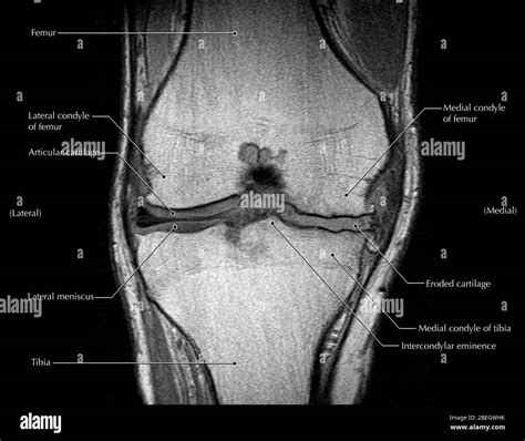 Knee Arthritis, MRI Stock Photo - Alamy