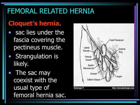 PPT - FEMORAL HERNIA & SLIDING HERNIA PowerPoint Presentation - ID:9423392