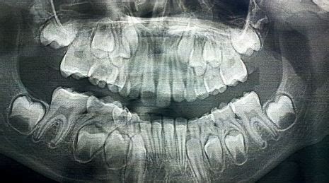 X-rays of kids’ skulls as their baby teeth get pushed out and their permanent teeth grow in ...