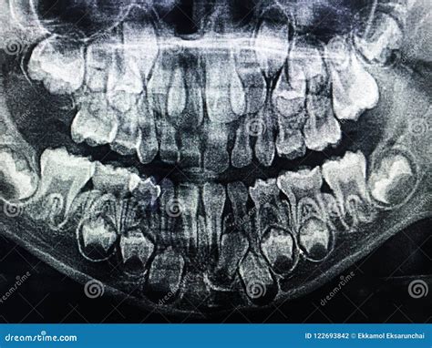 Dental X-Ray of Child 6 Years, All Baby Teeth in View. Stock Photo - Image of medical, female ...