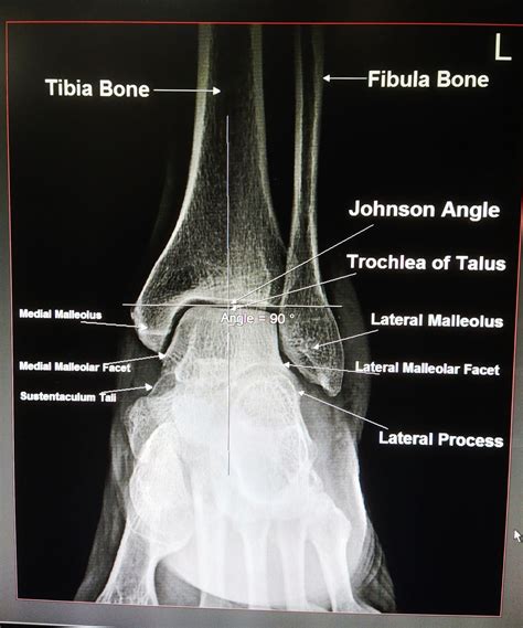 https://youtube.com/channel/UCWczKxCS6_AKGiHCXvi63DQ Ankle Joint, Ct Scan, Radiology, X Ray ...