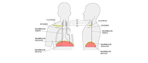 Diaphragm paralysis | Atrotech