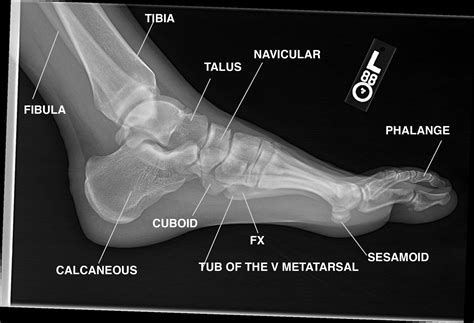 Foot Xray Anatomy