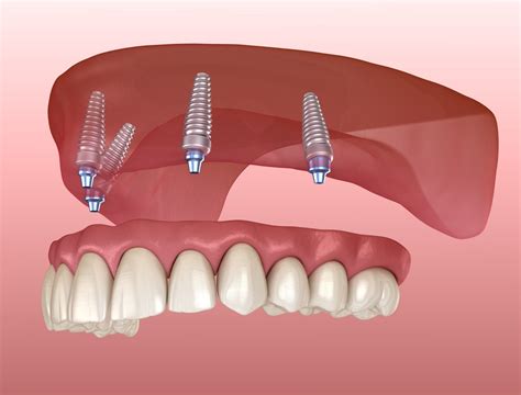 Dental Implants & Implant Fixed Dentures - Tulsa Precision Dental