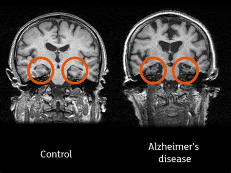 All you need to know about brain scans and dementia - Alzheimer's Research UK