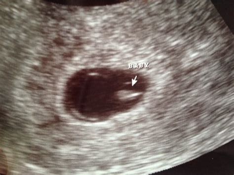 Spotting so got early ultrasound, 2 weeks off of LMP! *ultrasound pic* - BabyCenter