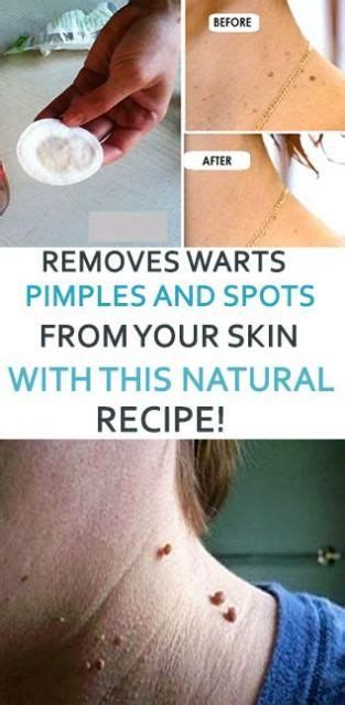 How To Remove Warts On Elbow - HOWTOREMVO