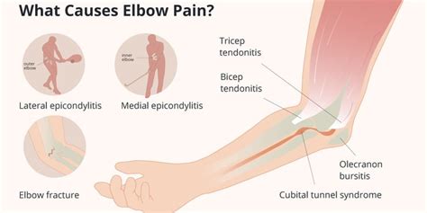 Elbow (Olecranon) Bursitis: Symptoms, Causes Treatment, 47% OFF