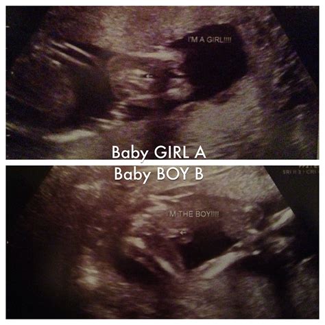 12 Week Ultrasound Girl Vs Boy